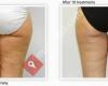 Cellulite Treatments by Sia Castle Hill