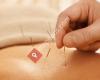 Element Acupuncture - Fusion Acupuncture, Chinese Herbal Consultation